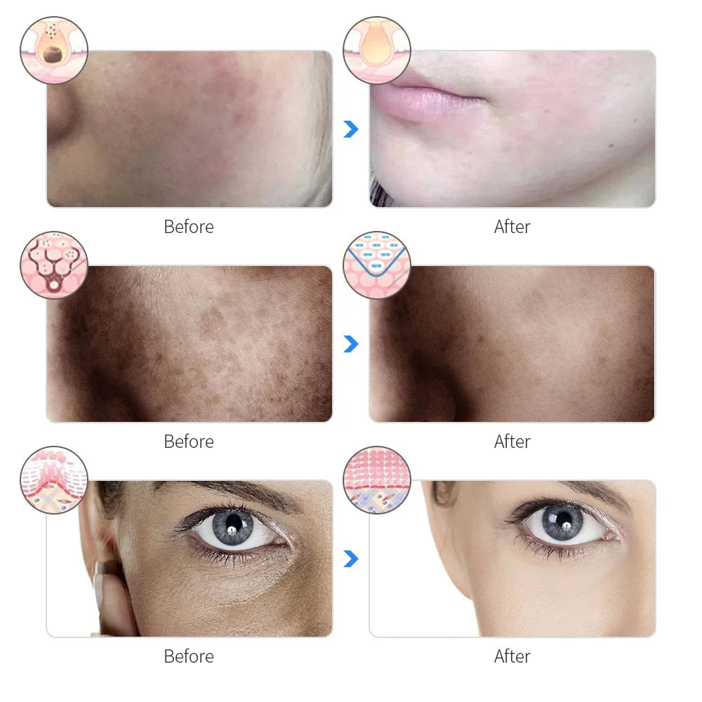 Máscara Facial LED 7 Cores para rejuvenescimento, tratamento antiacne e antirrugas.